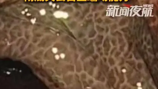 嚇！陸女狂喝通便茶10年赫見「豹紋腸」　發黑壞死切30cm