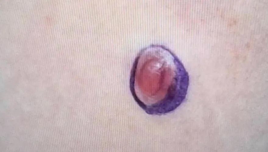 14歲弟肚皮長痘痘狂摳　醫生一切片嚇傻：竟然是這癌！