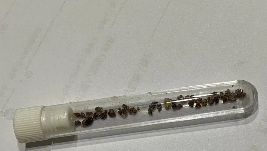 男子腰痛血尿打兩次碎石術無效！換刀一次清36顆結石