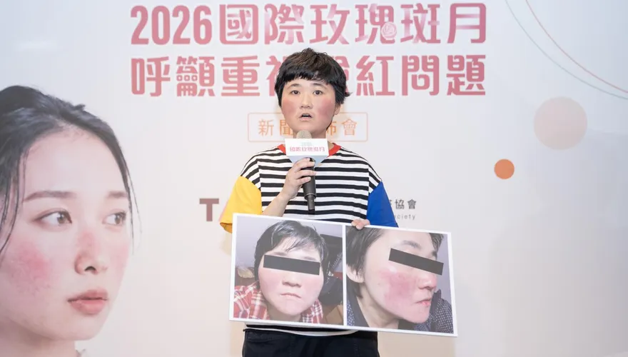 臉紅6年被當異位性皮膚炎！30歲女性確診玫瑰斑　治療後生活品質改善