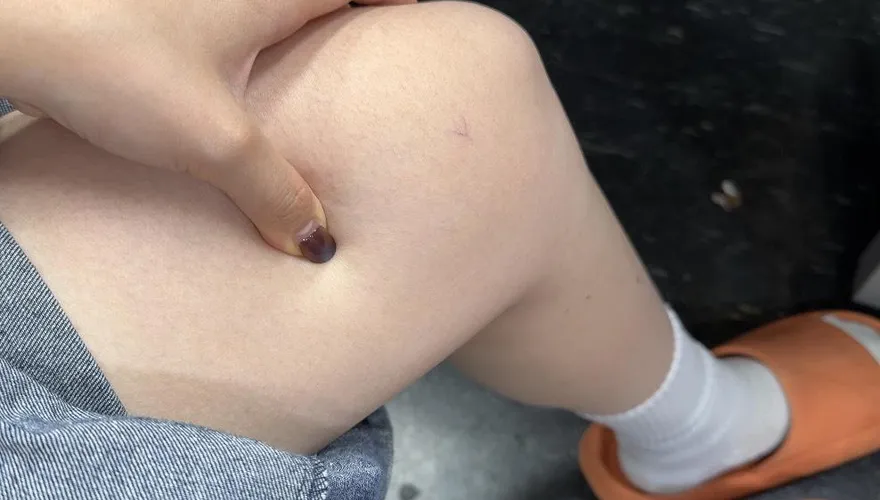 健康我+1/水腫合併「這些症狀」 醫：洗腎、猝死、癌症一起報到！