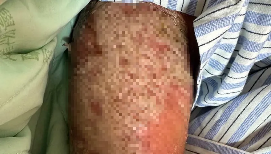 24歲男染新冠竟引發全身膿疱！罕見基因突變「1藥物」治癒