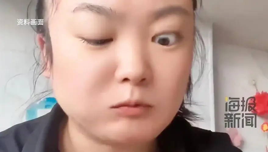影/咀嚼時眼睛會動？陸女一吃東西變「大小眼」　醫揭罕見真相