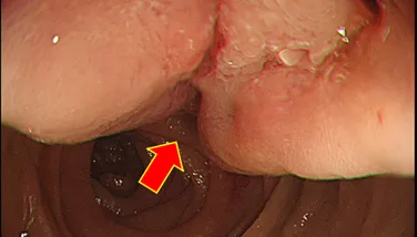 腹脹黑便半年竟藏20公分巨瘤！醫：手術難度如拆炸彈