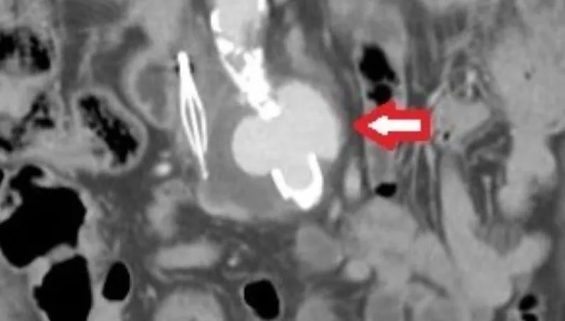 7旬嬤腸炎回診竟驚見「主動脈破兩處」　險喪命卻完全不痛！