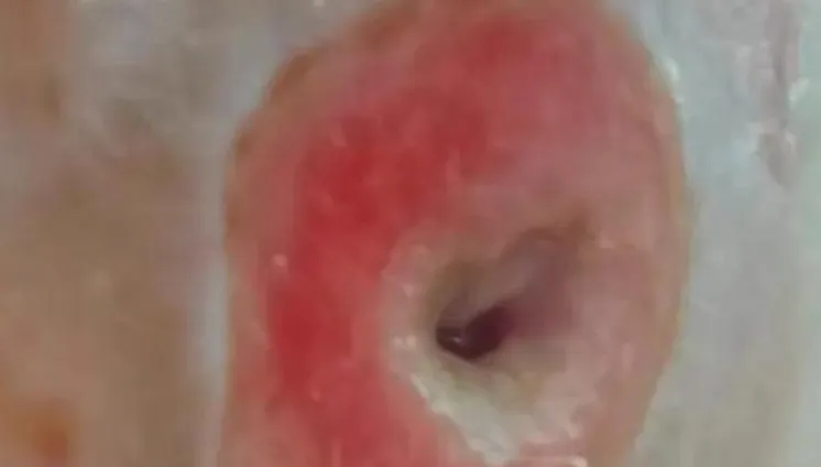 嚇！陸女誤把「皮脂腺囊腫」當痘痘擠　臉部驚現「恐怖黑洞」