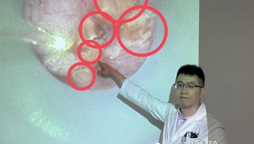 追劇忘喝水！婦半年三度腎結石　雙腎佈滿結石如雜糧麵包