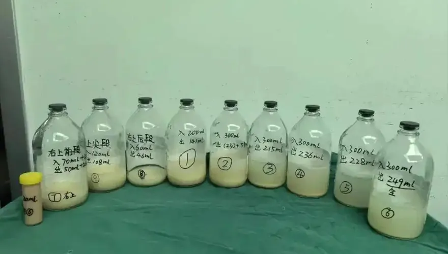 肺洗出3L「牛奶」！陸女童久咳2個月　醫揭患「肺泡蛋白沉積症」