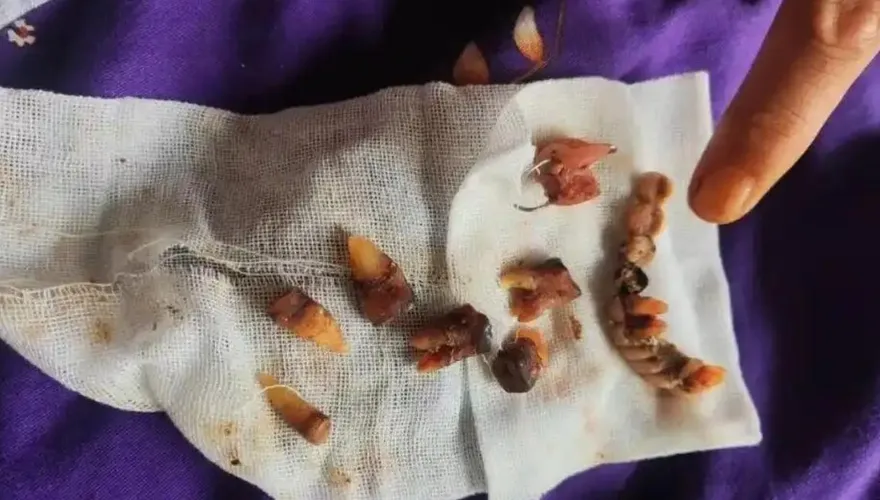 看一顆牙竟拔光12顆！陸翁遭過度植牙「滿嘴血」存款全被刷光