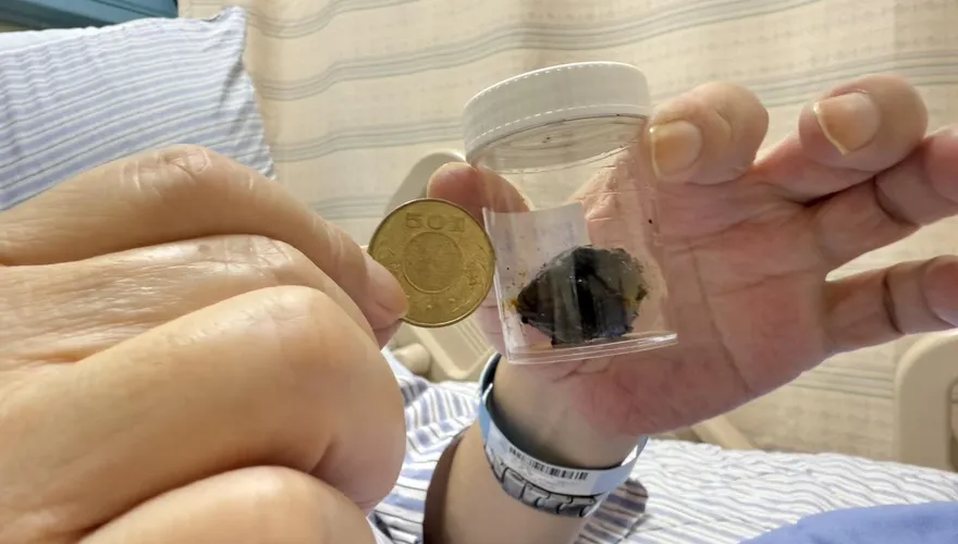 沒症狀的膽結石更危險！59歲男肝指數暴衝550