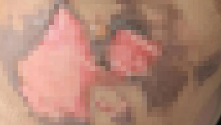 拔罐慘被燒！火苗突掉落「引燃床單」　陸女皮膚燒掉慘不忍睹