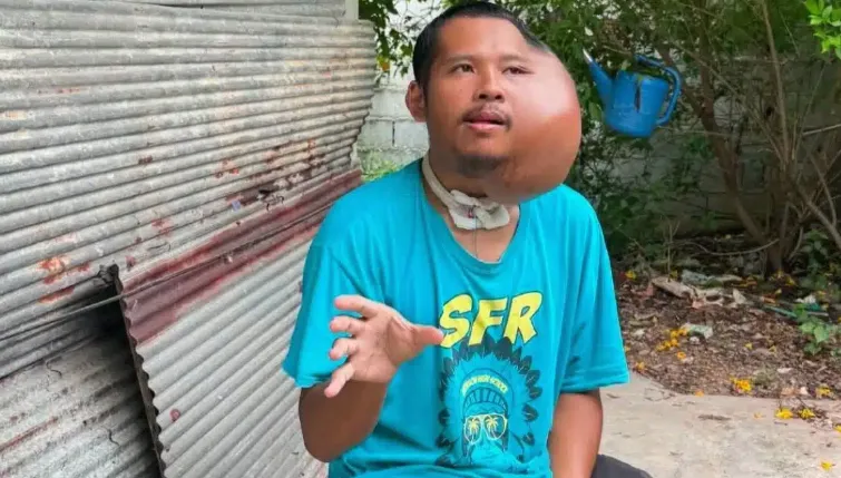 泰男牙籤剔牙「左臉長出巨大腫瘤」 求助遭酸AI造假