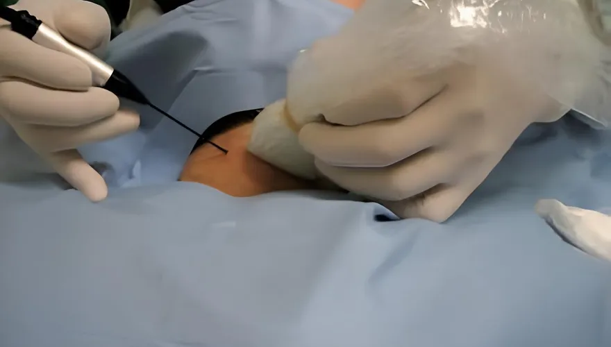 甲狀腺結節一定要開刀？60歲婦靠「射頻消融」縮小腫塊