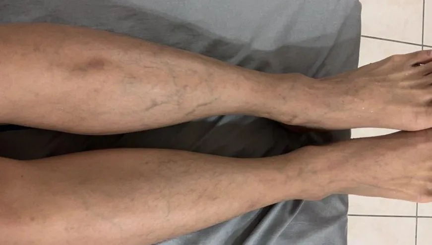 雙腿潰瘍痛到走不了！25歲男「幹細胞移植」擺脫罕病