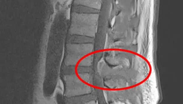 他腰痛發燒2週不是感冒！檢查竟發現細菌入侵脊椎、心臟