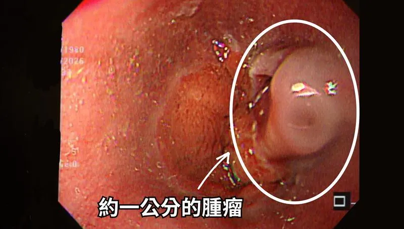長期胃食道逆流竟吐血！竹科男確診食道癌