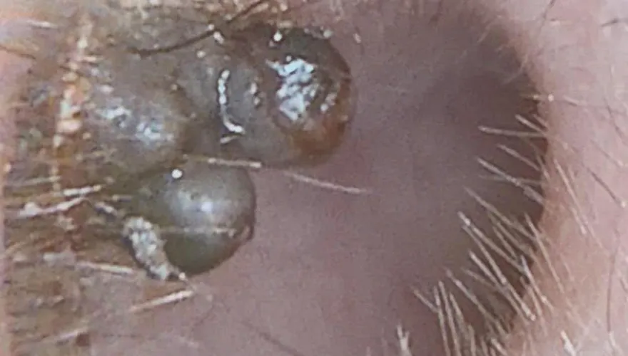 自行掏耳朵嚇壞！耳道驚見「一坨黑色珍珠」竟是痣