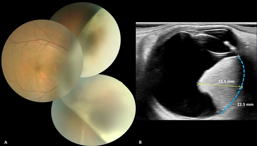 36歲女眼內有巨大腫瘤！北榮切除2公分惡性瘤保住視力