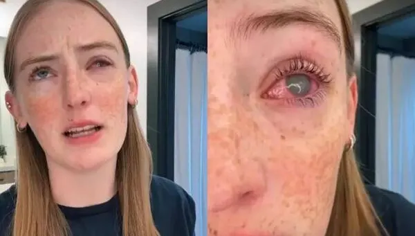 阿米巴原蟲入侵！美19歲少女「戴隱形眼鏡洗澡」慘失明