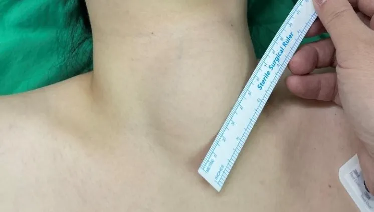 脖子卡卡、吞嚥不順！30多歲女揪出8公分甲狀腺結節