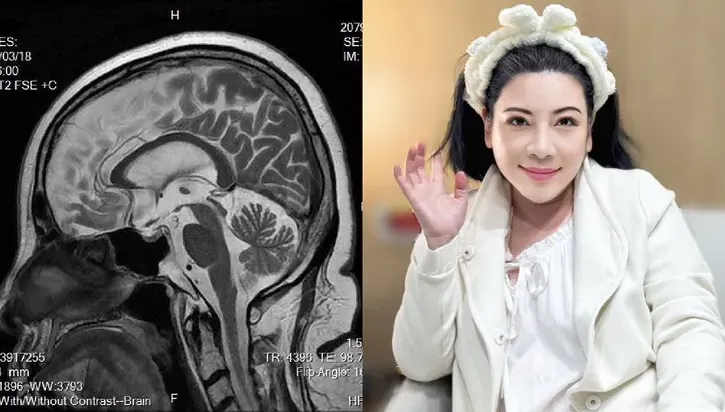 陳文茜秀「腦部MRI影像」曝病況　嘆：去年此時癌細胞激增！