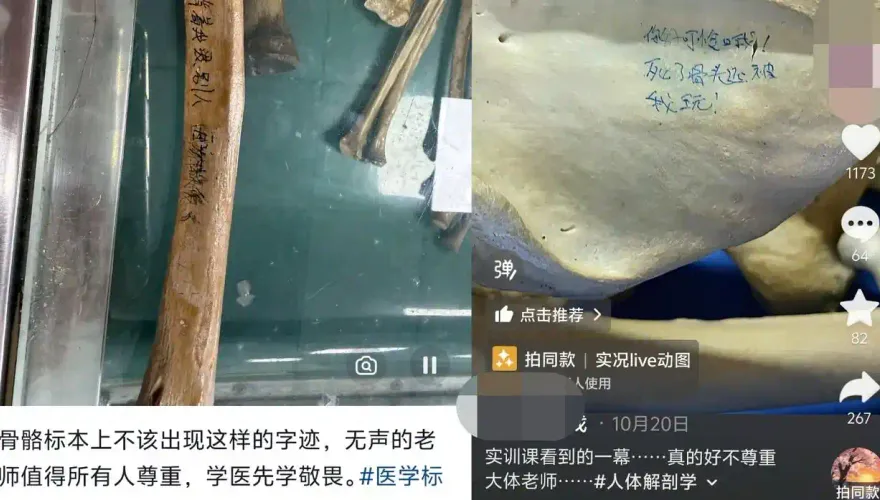 陸醫學生玩頭骨還留輕佻字句！「死了骨頭還要被我玩」惹怒全網