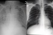 感染新冠會變「白肺」？話題衝微博熱搜！醫提醒：這症狀及時就醫