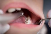 女星牙齒變色痛到無法工作！就醫發現「增生小牙」緊急根管治療