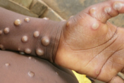 新增20例猴痘！疾管署籲符合「近6個月內曾有高風險性行為」對象儘速接種疫苗
