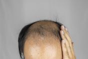 男性平均每5人就有1人有禿頭！營養師激推「5類食物」還你濃密髮