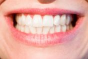 牙齒矯正沒有年齡限制！牙醫：除了美觀　可改善「咬合不正、牙周病」健康問題