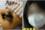 少女腰部長出「一叢濃密黑森林」　就醫竟是這裡有問題