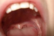 39歲女口腔潰爛一年未癒　因罹癌被迫「割舌」喪失說話能力