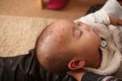 曾染水痘是皮蛇"帶狀皰疹"潛在患者    打疫苗減少發生率!