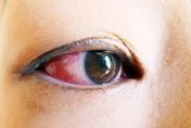 眼睛怎麼紅紅的？「結膜下出血」要警覺　醫示警：中風機率較高