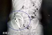 4歲女童「腹痛一個月」就醫驚見「61顆磁力球」　醫：毀了一輩子！