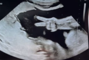 絕了！31周胎兒「肚裡比YA」父母瞬間笑噴　無私分享超音波照