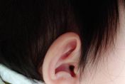 5歲童耳朵感染一個月治不好　就醫發現竟是「電池卡食道」釀病！