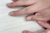 7歲女童指甲「多處斷裂」　醫一看驚是「腸病毒」釀禍！