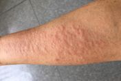 入春後「濕疹」將大爆發！ 花粉、梅雨恐讓病情惡化　專家警告：6件事最傷皮膚