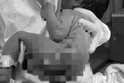 出生4小時就出事！女嬰全身25％皮膚遭燙傷脫落　粗心護理師遭起訴