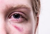 影/美臨床發現25％猴痘患者合併「結膜炎」！眼科醫師：嚴重恐視力永久下降