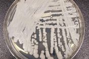 美爆發「超級真菌」感染 ！具抗藥性50％患者90天後死亡