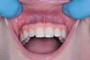 婦口腔顎骨隆突無法裝假牙　醫「手術切除成功」助重拾美味！