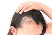 頭皮出現3大症狀是初老症狀 　別信偏方！正確預防「雄性禿」４要點