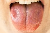經常咬到舌頭原因曝　專家示警「2狀況」快就醫