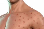 猴痘也有「無症狀感染」！專家曝輕忽後果　估5、6月達高峰