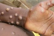 6月新增猴痘106例！陸CDC：主要通過「男男性行為」接觸傳播