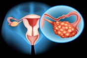 「多囊性卵巢」月經失調、體重飆升好難瘦！營養師授6項調理方式