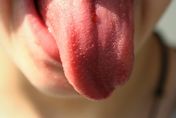反覆感冒未痊癒　醫一看舌頭竟缺「2營養素」節食造成